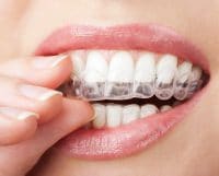 Invisalign for the Holidays Columbia SC